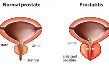 prostata