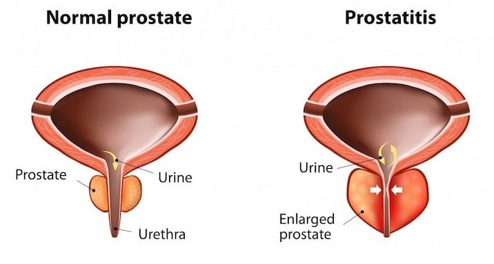 prostata