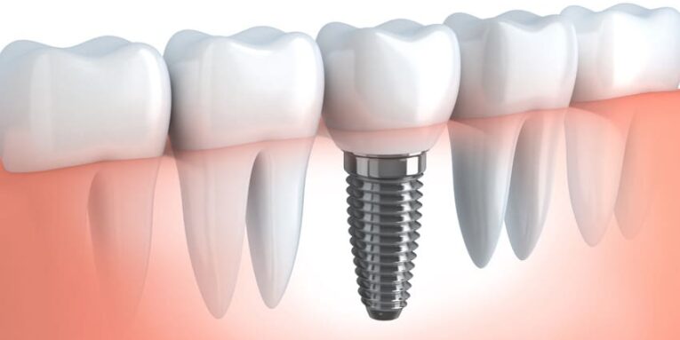 implantologia dentale